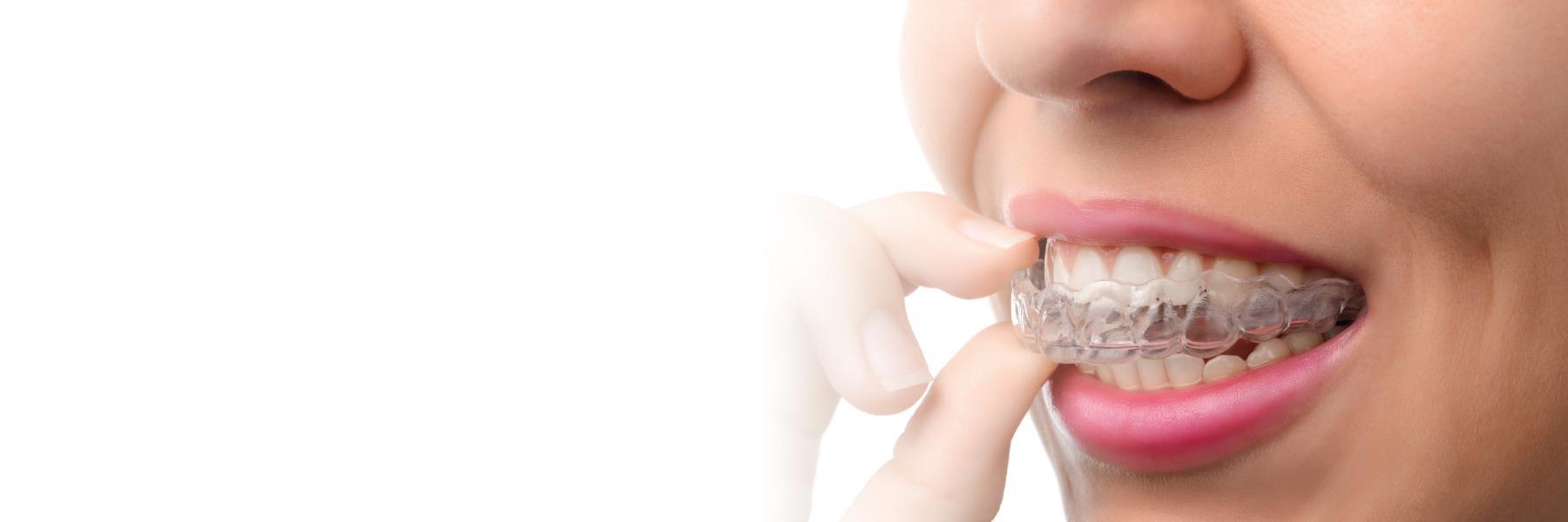 Bellevue patients with clear aligners